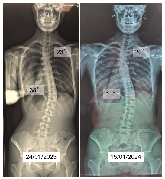 Spinal curve after one year of SSE